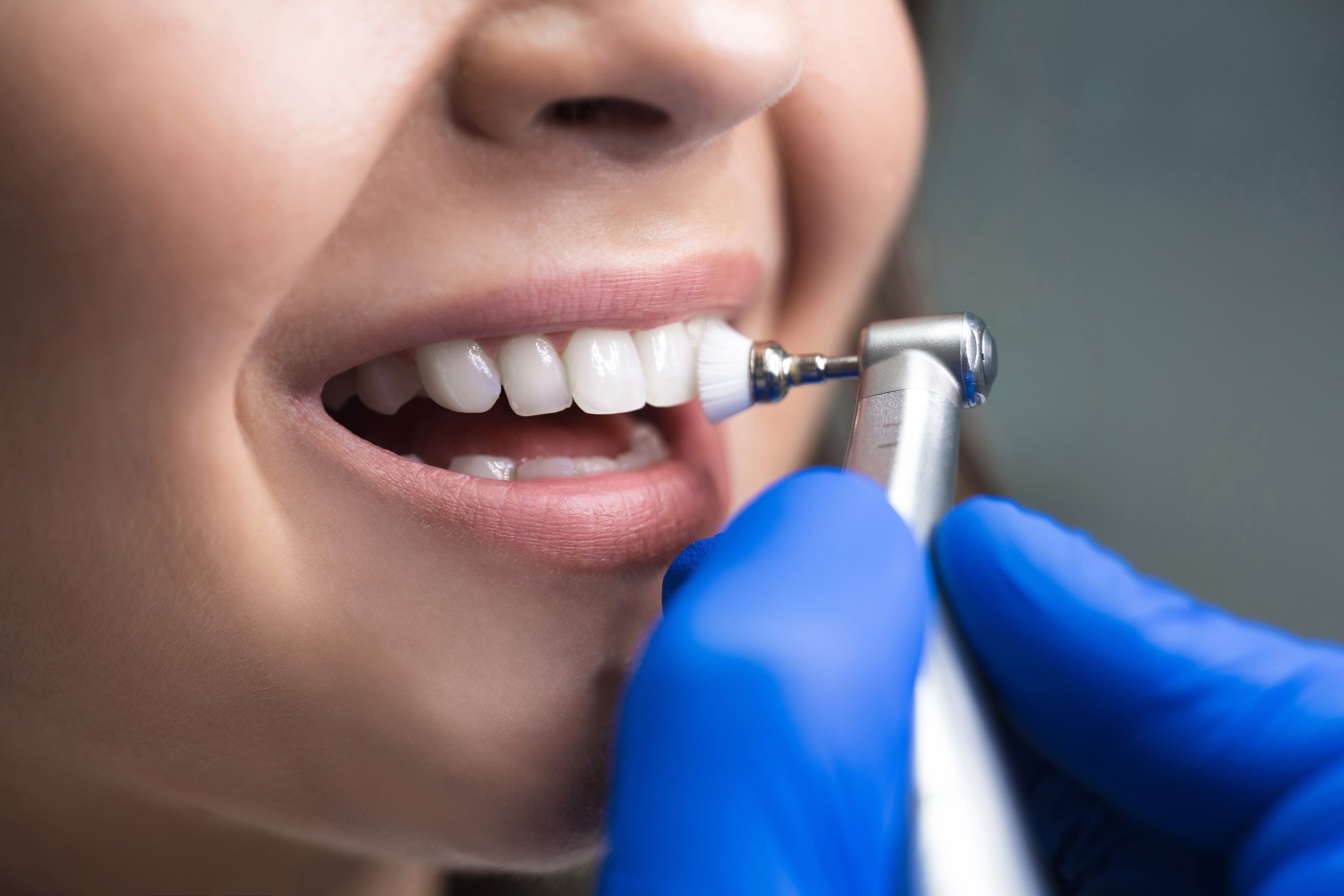 teeth cleaning in Chesterfield, MO